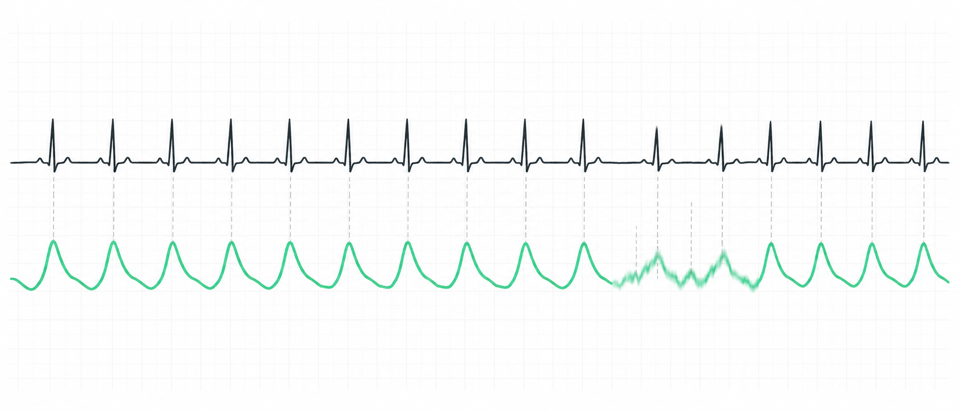 An ECG trace above a smoother pulse wave, with dashed lines matching each heartbeat; a blurred, noisy stretch of the pulse wave shows where the optical estimate loses track.
